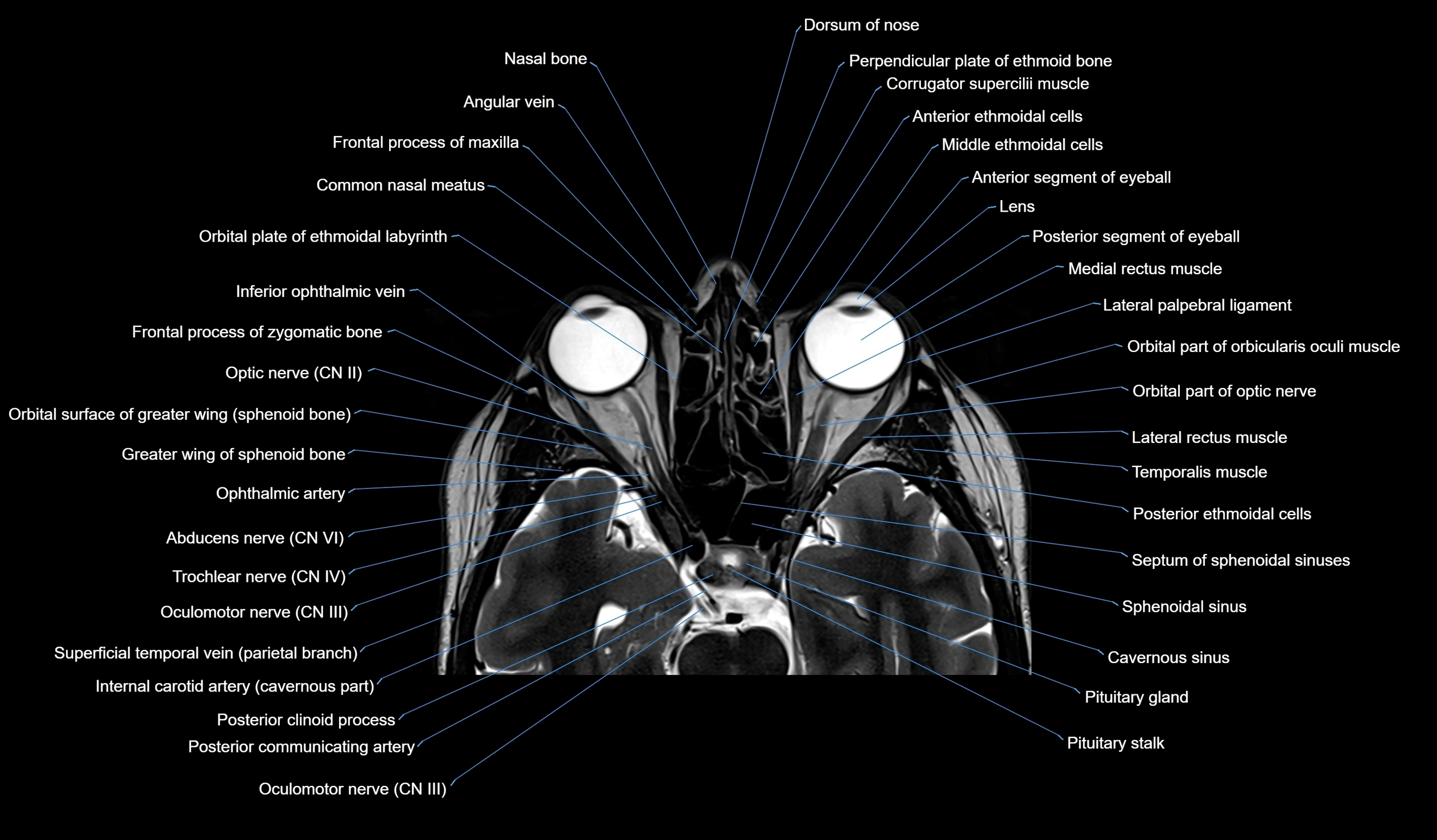 MRI face & paranasal sinuses(PNS) labelled  coronal  cross sectional anatomy 3T radiology  image-img-00001-00021.webp